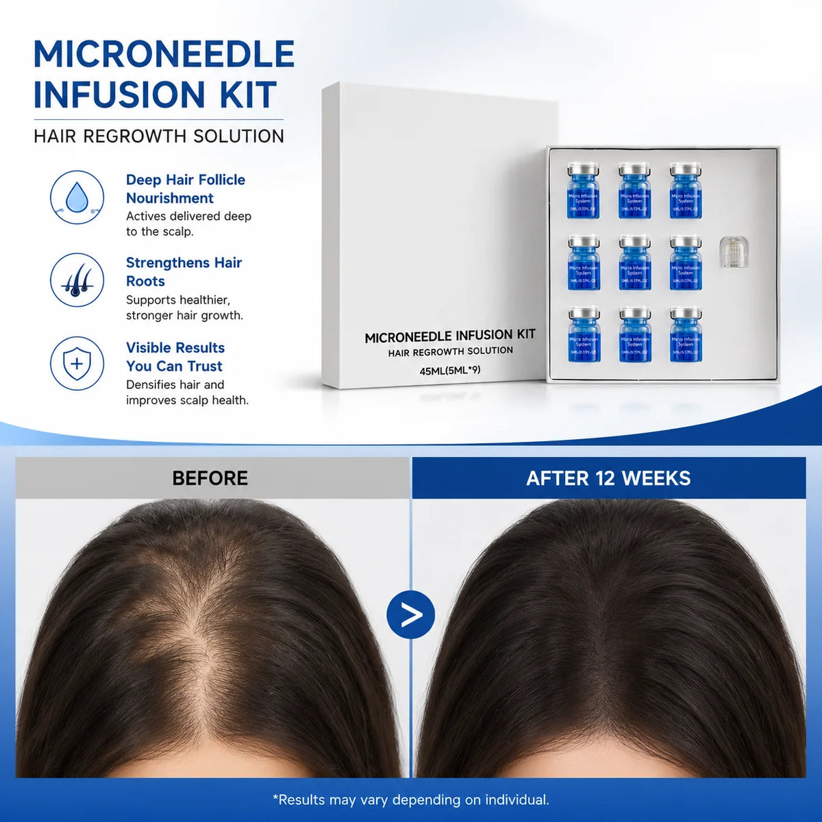 Microagujas para el crecimiento del cabello en un kit de Corporación Turística, con microagujas y soluciones para estimular el cabello.